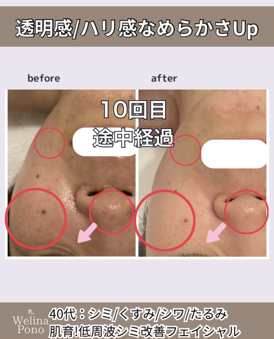 シミ改善フェイシャル メニュー比較ブログアイキャッチ