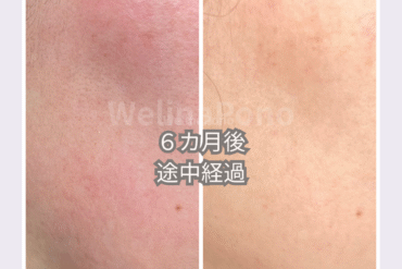 【札幌】幹細胞ホワイトスノーピールでシミ改善！60分で叶う透明美白肌