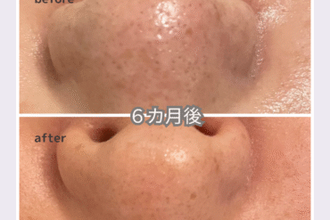 【ビフォーアフター公開】40代女性が白雪肌に変わった1年。乾燥・くすみ改善のリアル記録