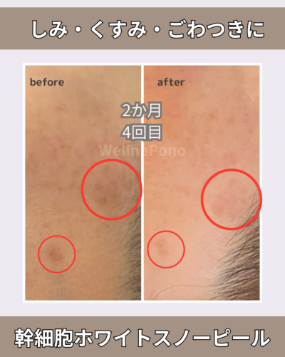 幹細胞ホワイトスノーピールでシミくすみごわつき撃退。札幌