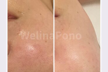 50代からの肌質改善｜毛穴・ざらつきがつるん!!札幌フェイシャル