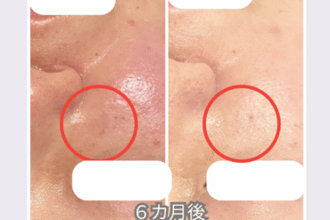 【札幌】40〜50代のシミ・色むら改善｜5回の継続ケアでここまで変わる理由