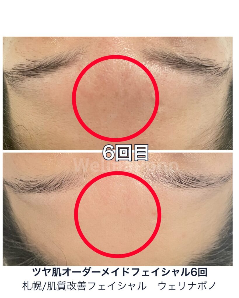 50代からの毛穴・凹凸改善