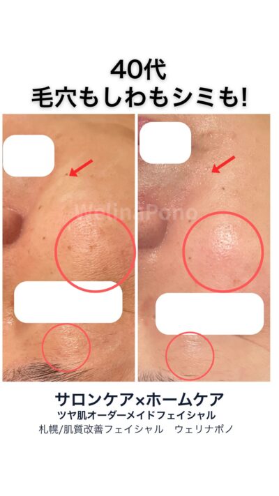 毛穴も引き締まりほうれい線もシミもうすく。参考イメージ