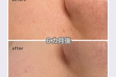 【ビフォーアフター公開】40代女性が白雪肌に変わった1年。乾燥・くすみ改善のリアル記録