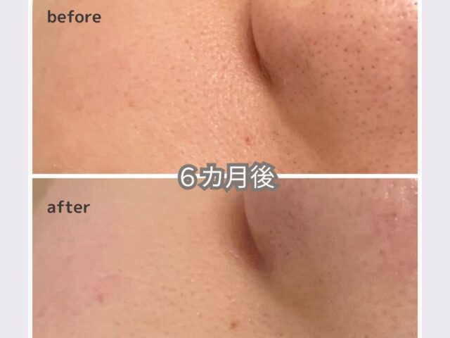 黒ずみ毛穴もスッキリ。頬の毛穴もキュッと引き締まったイメージ画像