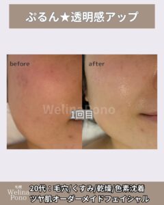一度で透明感アップ。色素沈着もうすく毛穴も小さく。