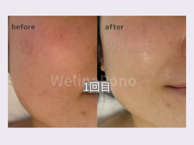 一度で透明感アップ。色素沈着もうすく毛穴も小さく。