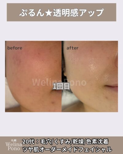 一度で透明感アップ。色素沈着もうすく毛穴も小さく。