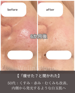 顔のくすみ・赤み・色むら改善のフェイシャルビフォーアフター｜札幌でシミ改善と透明感アップを叶えるウェリナポノ