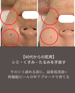 札幌のシミ改善ケア・低周波とホワイトスノーピールの比較ビフォーアフター｜40代からの肌質改善ウェリナポノ