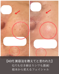 40代の毛穴引き締めとしわ改善ビフォーアフター｜根本から変える札幌の肌育フェイシャル・ウェリナポノ
