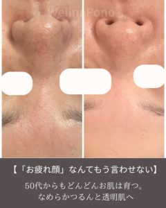 50代のシミ改善ごわつき改善ビフォーアフター｜くすみや乾燥ともさようなら札幌の肌育フェイシャル・ウェリナポノ
