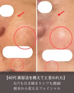 しわもシミも赤みもくすみも改善。イメージ画像。フェイシャルエステ