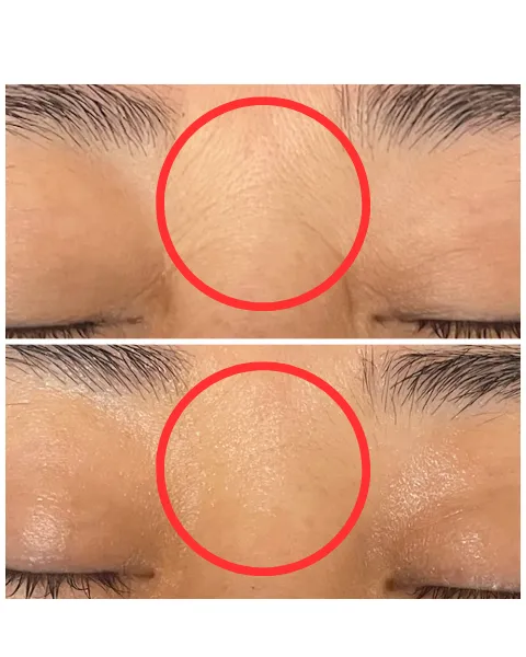 札幌・西18丁目のフェイシャルエステ「Welina Pono」による、40代女性の肌質改善・ハリ弾力ケアの施術前後比較（ビフォーアフター）写真