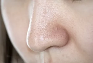 なぜ吸引しても黒ずむの？プロが教える「毛穴レス」への近道