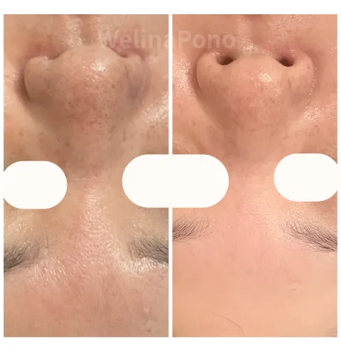 50代女性のお悩み。ごわつき・毛穴開き、しわ改善