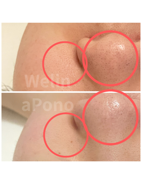 札幌の超高濃度水素フェイシャル|毛穴開き・毛穴詰まりが気になるお客様のBefore After|Welina Pono
