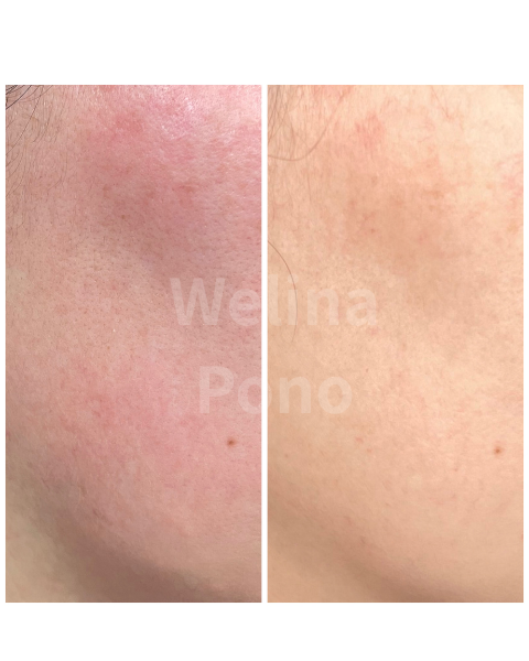 札幌の超高濃度水素フェイシャル|赤み・肌荒れが気になるお客様のBefore After|Welina Pono